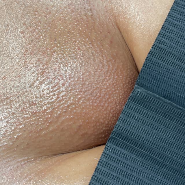 Smooth Starter (3 MONTHS) at Beauty By Yuliana in Orange, CA